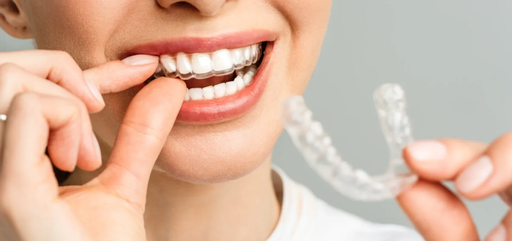 Orthodontiste adulte Puteaux 92800