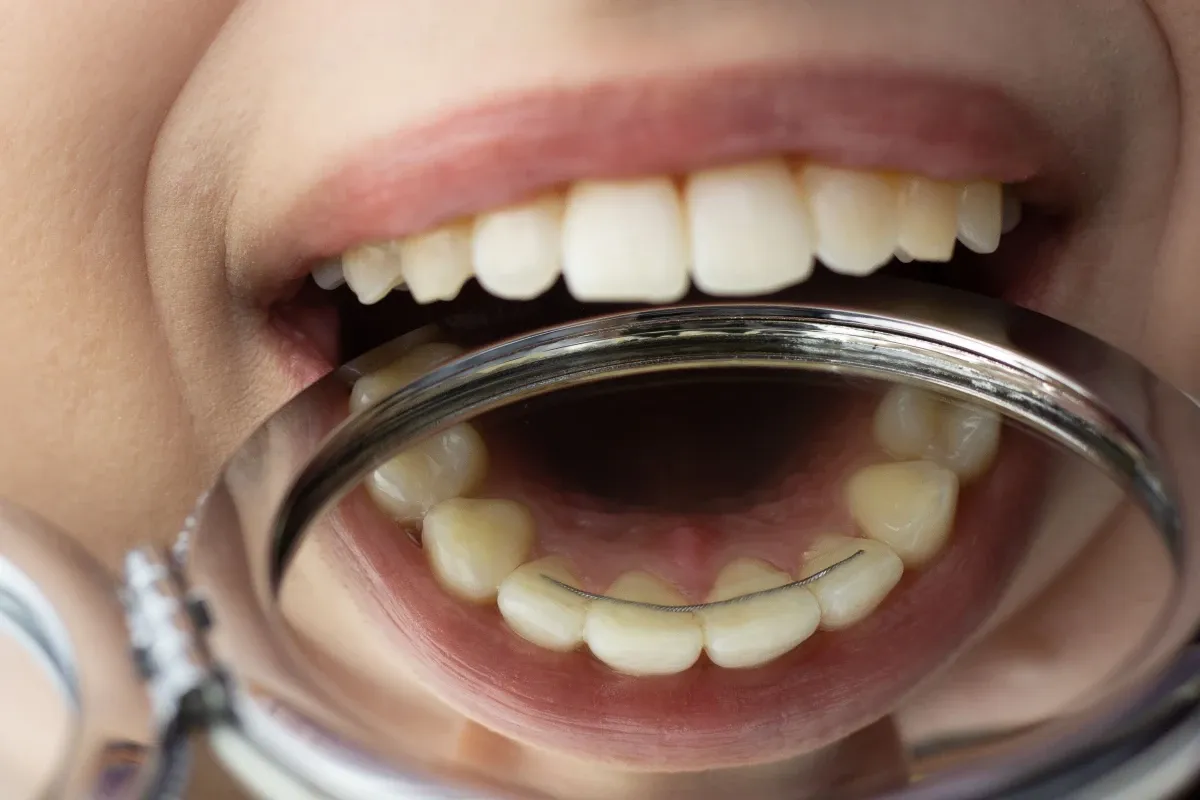 Orthodontiste adolescent Puteaux 92800