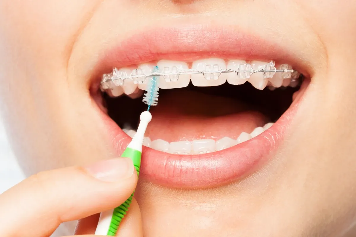 Orthodontiste adolescent Puteaux 92800